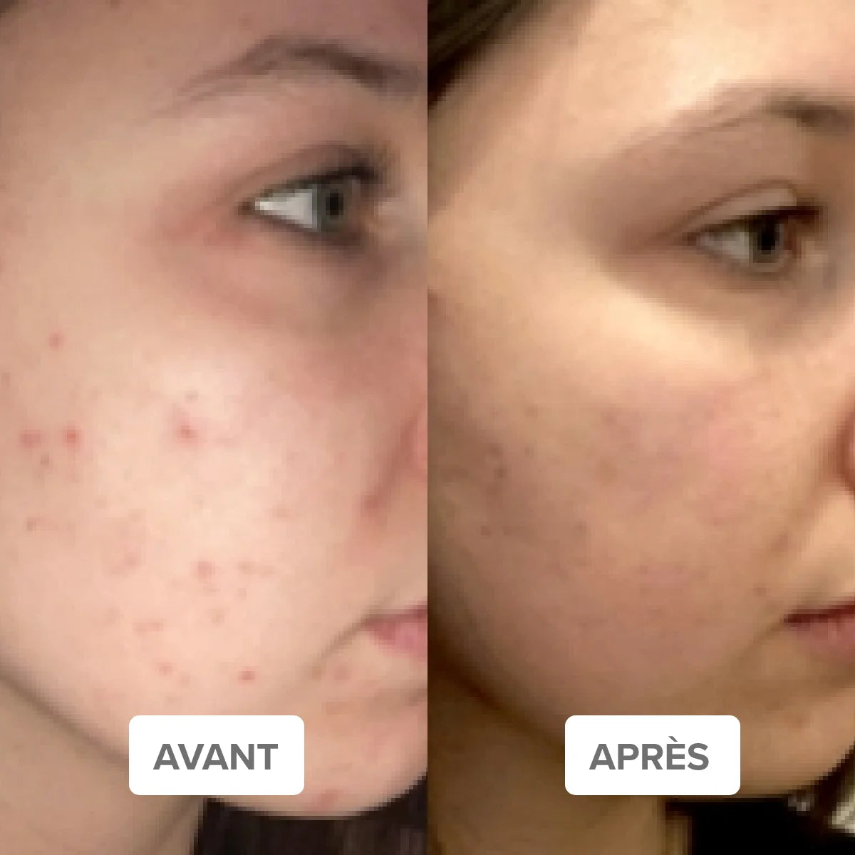 ROUTINE PEAU ZÉRO DÉFAUT – Soin Complet pour Peau Acnéique | Mademoiselle Agathe